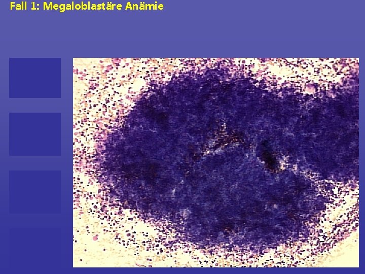 Fall 1: Megaloblastäre Anämie 