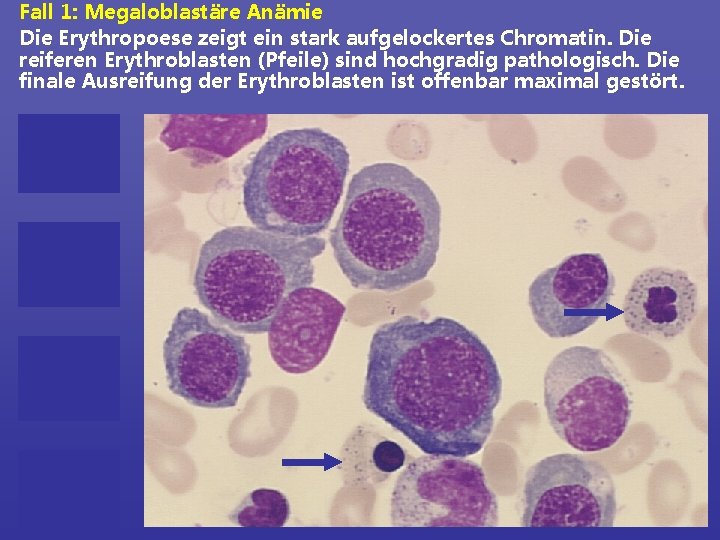 Fall 1: Megaloblastäre Anämie Die Erythropoese zeigt ein stark aufgelockertes Chromatin. Die reiferen Erythroblasten