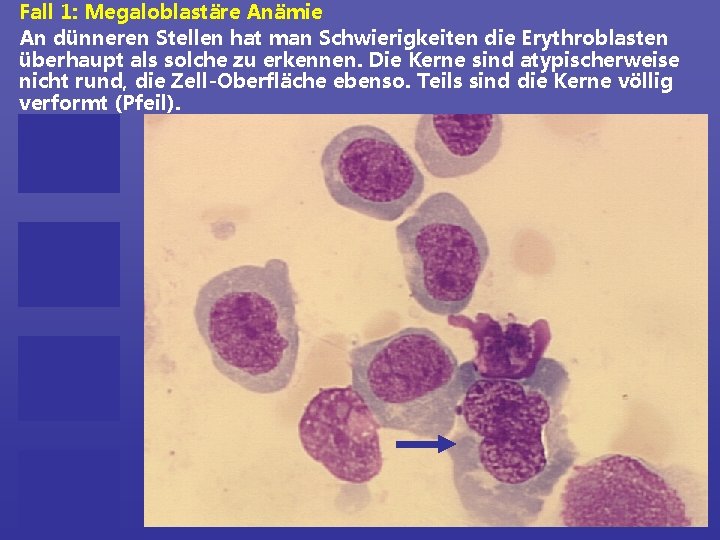 Fall 1: Megaloblastäre Anämie An dünneren Stellen hat man Schwierigkeiten die Erythroblasten überhaupt als