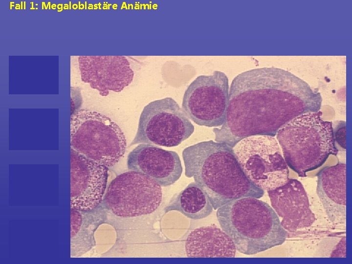 Fall 1: Megaloblastäre Anämie 