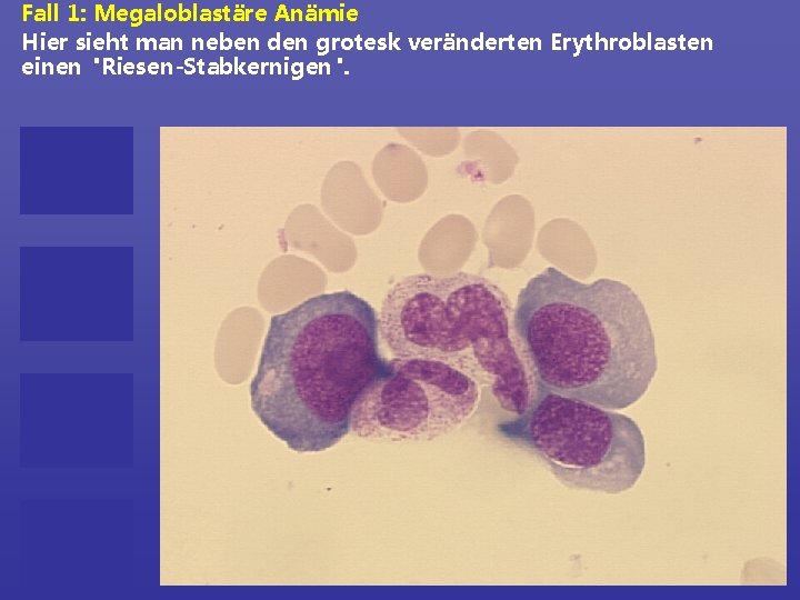 Fall 1: Megaloblastäre Anämie Hier sieht man neben den grotesk veränderten Erythroblasten einen "Riesen-Stabkernigen".