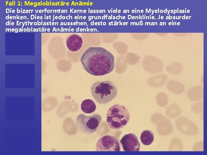Fall 1: Megaloblastäre Anämie Die bizarr verformten Kerne lassen viele an eine Myelodysplasie denken.