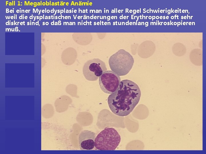 Fall 1: Megaloblastäre Anämie Bei einer Myelodysplasie hat man in aller Regel Schwierigkeiten, weil