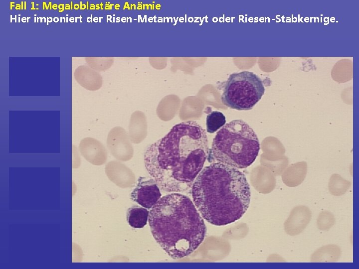 Fall 1: Megaloblastäre Anämie Hier imponiert der Risen-Metamyelozyt oder Riesen-Stabkernige. 