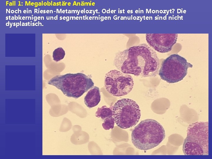 Fall 1: Megaloblastäre Anämie Noch ein Riesen-Metamyelozyt. Oder ist es ein Monozyt? Die stabkernigen