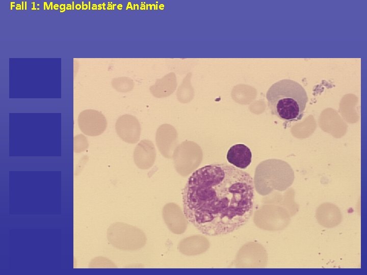 Fall 1: Megaloblastäre Anämie 