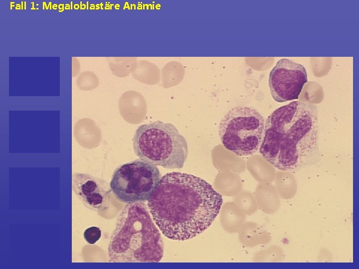 Fall 1: Megaloblastäre Anämie 