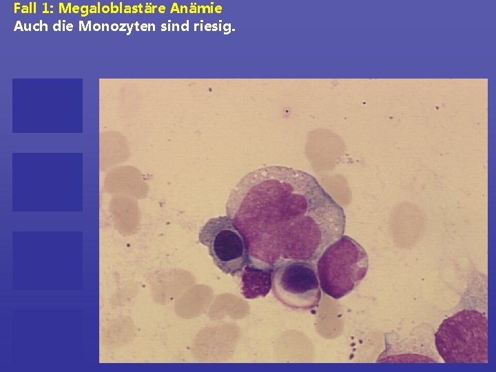 Fall 1: Megaloblastäre Anämie Auch die Monozyten sind riesig. 