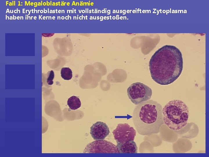 Fall 1: Megaloblastäre Anämie Auch Erythroblasten mit vollständig ausgereiftem Zytoplasma haben ihre Kerne noch