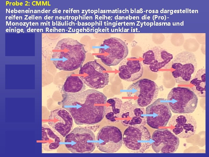 Probe 2: CMML Nebeneinander die reifen zytoplasmatisch blaß-rosa dargestellten reifen Zellen der neutrophilen Reihe;