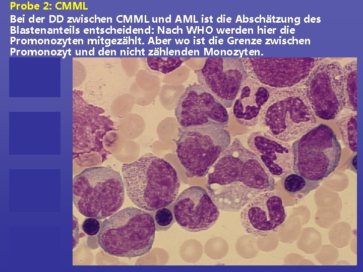 Probe 2: CMML Bei der DD zwischen CMML und AML ist die Abschätzung des