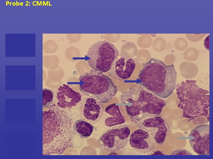 Probe 2: CMML 