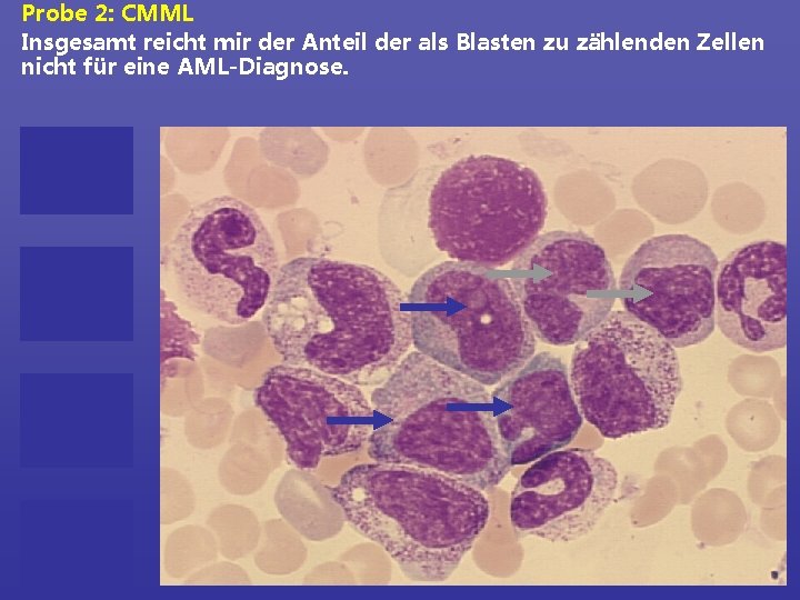 Probe 2: CMML Insgesamt reicht mir der Anteil der als Blasten zu zählenden Zellen