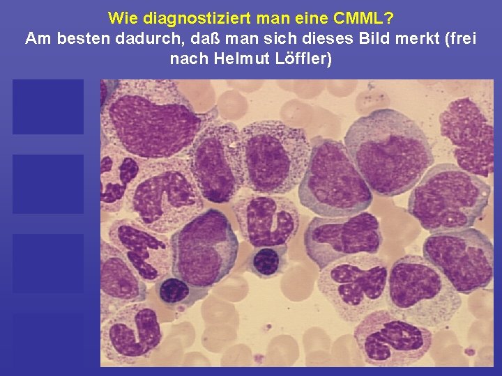 Wie diagnostiziert man eine CMML? Am besten dadurch, daß man sich dieses Bild merkt