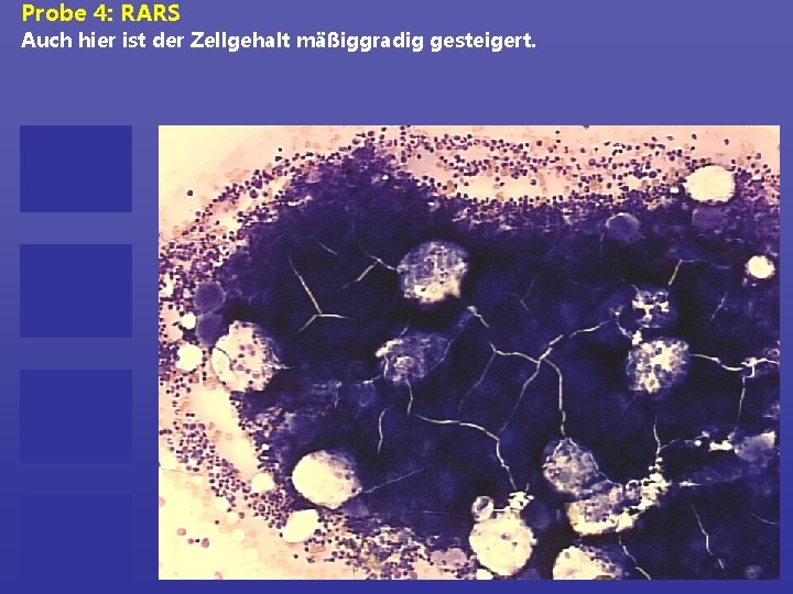 Probe 4: RARS Auch hier ist der Zellgehalt mäßiggradig gesteigert. 