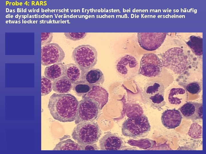 Probe 4: RARS Das Bild wird beherrscht von Erythroblasten, bei denen man wie so