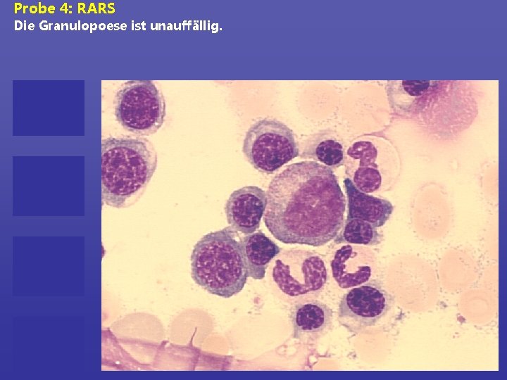 Probe 4: RARS Die Granulopoese ist unauffällig. 