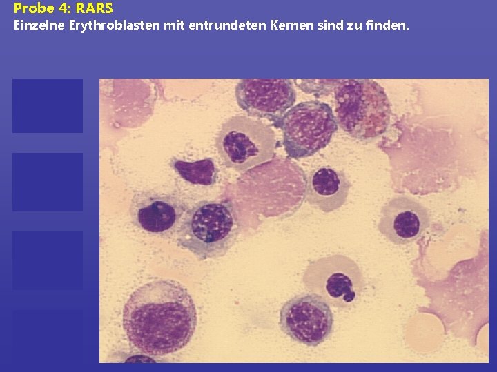 Probe 4: RARS Einzelne Erythroblasten mit entrundeten Kernen sind zu finden. 
