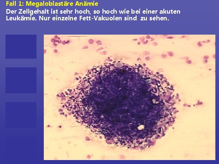 Fall 1: Megaloblastäre Anämie Der Zellgehalt ist sehr hoch, so hoch wie bei einer