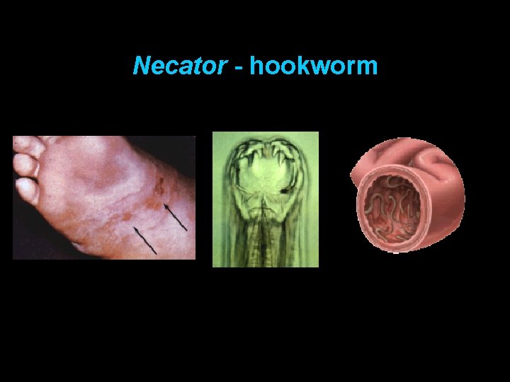 Necator - hookworm 