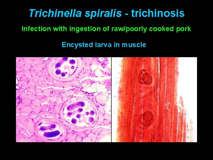 Trichinella spiralis - trichinosis Infection with ingestion of raw/poorly cooked pork Encysted larva in