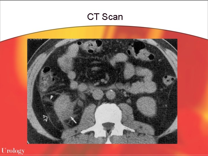 CT Scan 