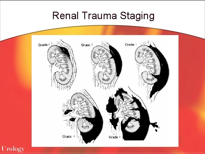 Renal Trauma Staging 