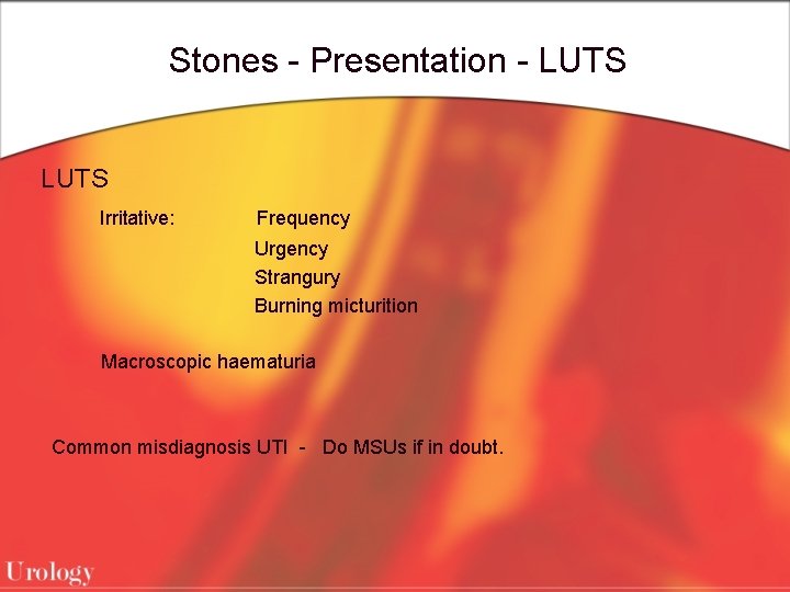 Stones - Presentation - LUTS Irritative: Frequency Urgency Strangury Burning micturition Macroscopic haematuria Common