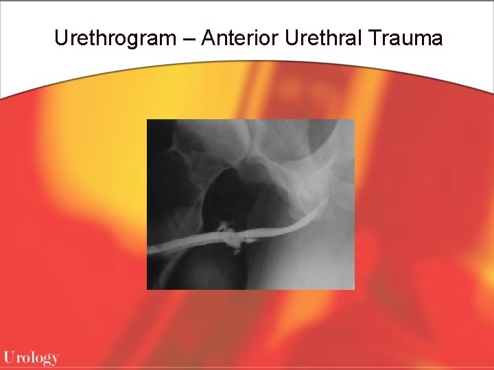 Urethrogram – Anterior Urethral Trauma 