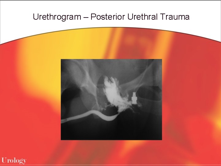 Urethrogram – Posterior Urethral Trauma 