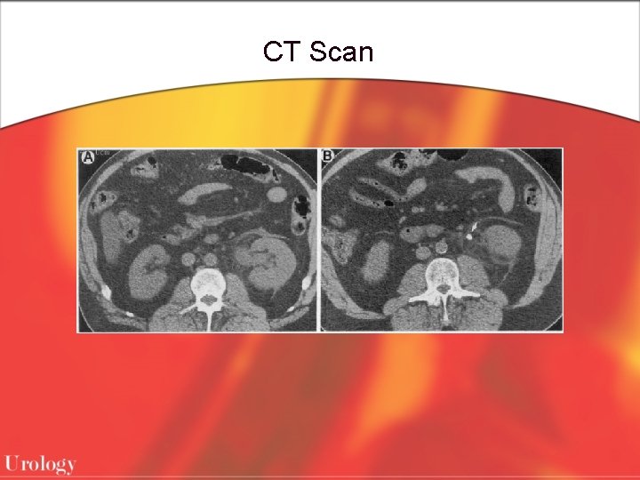 CT Scan 