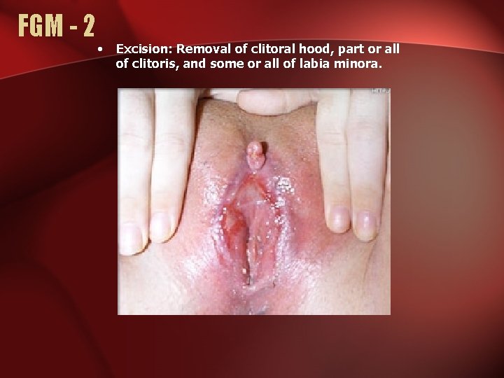 FGM - 2 • Excision: Removal of clitoral hood, part or all of clitoris,