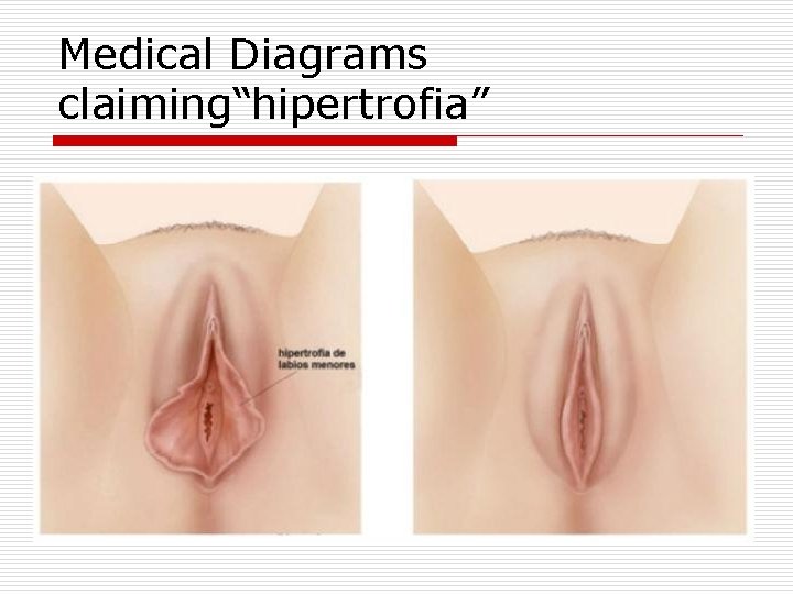 Medical Diagrams claiming“hipertrofia” 