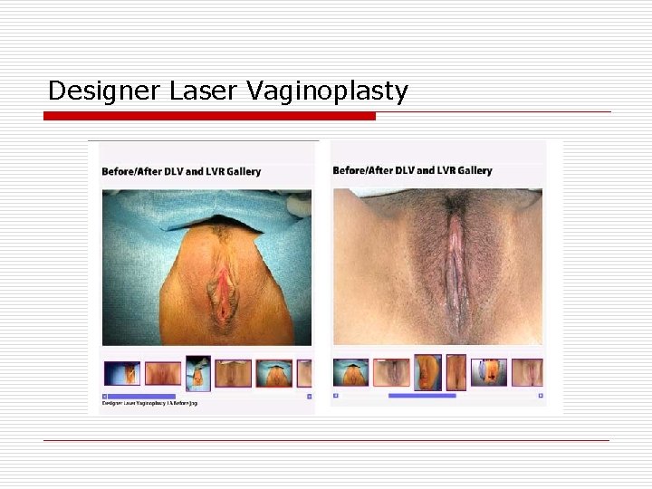 Designer Laser Vaginoplasty 