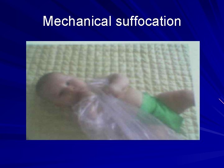 Mechanical suffocation 