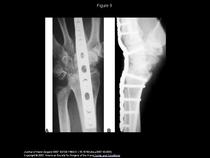 Figure 9 Journal of Hand Surgery 2007 32725 -746 DOI: (10. 1016/j. jhsa. 2007.