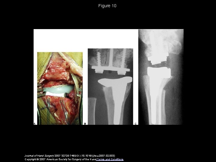 Figure 10 Journal of Hand Surgery 2007 32725 -746 DOI: (10. 1016/j. jhsa. 2007.