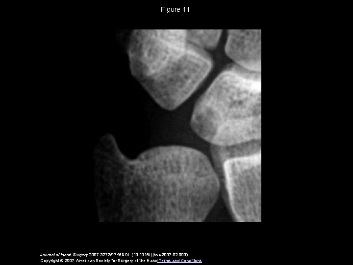Figure 11 Journal of Hand Surgery 2007 32725 -746 DOI: (10. 1016/j. jhsa. 2007.