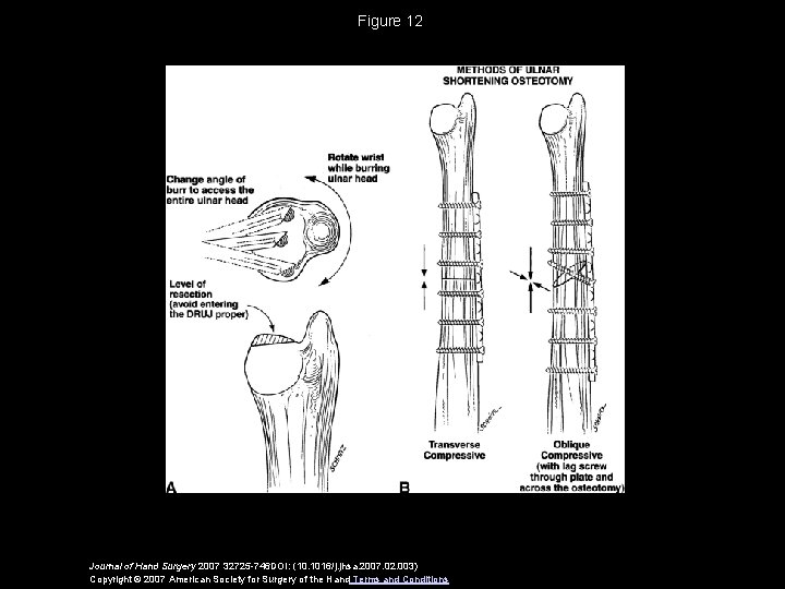 Figure 12 Journal of Hand Surgery 2007 32725 -746 DOI: (10. 1016/j. jhsa. 2007.