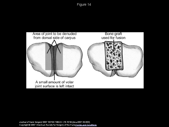 Figure 14 Journal of Hand Surgery 2007 32725 -746 DOI: (10. 1016/j. jhsa. 2007.