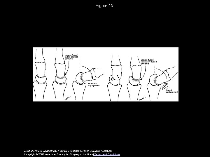 Figure 15 Journal of Hand Surgery 2007 32725 -746 DOI: (10. 1016/j. jhsa. 2007.