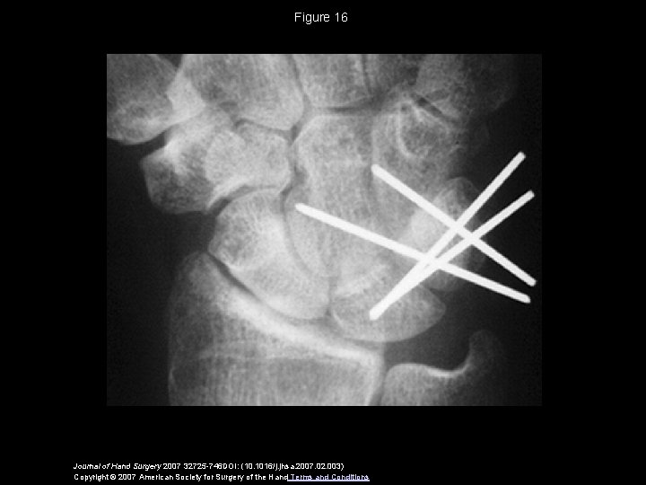 Figure 16 Journal of Hand Surgery 2007 32725 -746 DOI: (10. 1016/j. jhsa. 2007.