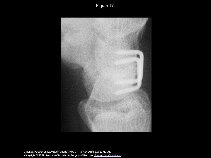 Figure 17 Journal of Hand Surgery 2007 32725 -746 DOI: (10. 1016/j. jhsa. 2007.