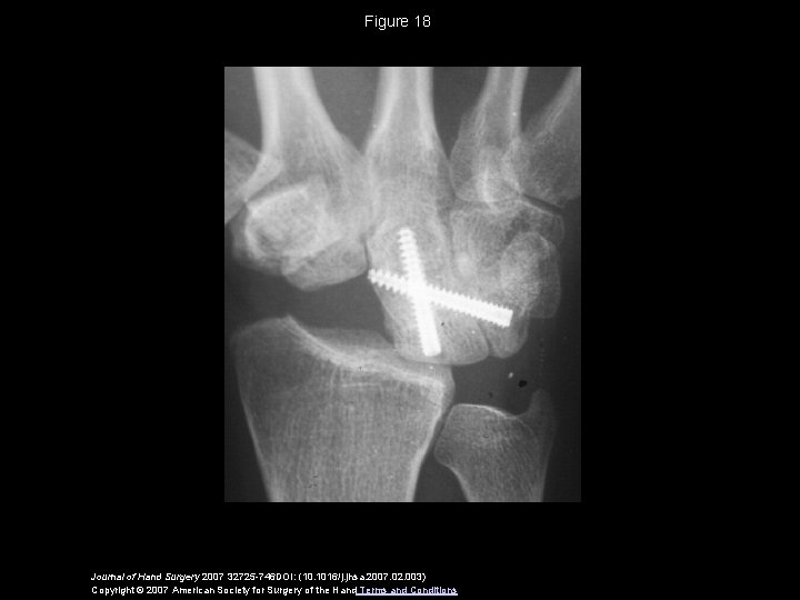 Figure 18 Journal of Hand Surgery 2007 32725 -746 DOI: (10. 1016/j. jhsa. 2007.