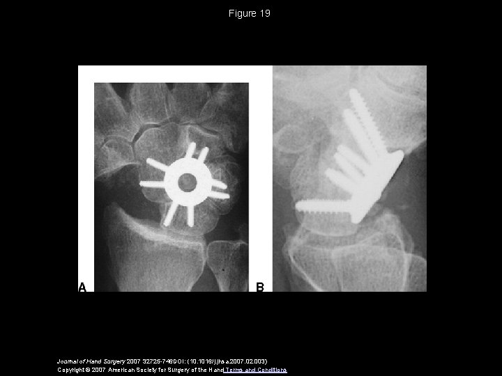 Figure 19 Journal of Hand Surgery 2007 32725 -746 DOI: (10. 1016/j. jhsa. 2007.