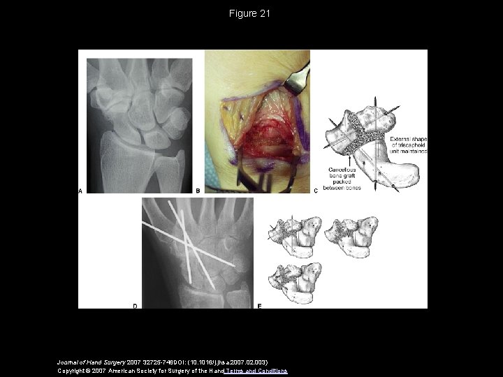 Figure 21 Journal of Hand Surgery 2007 32725 -746 DOI: (10. 1016/j. jhsa. 2007.