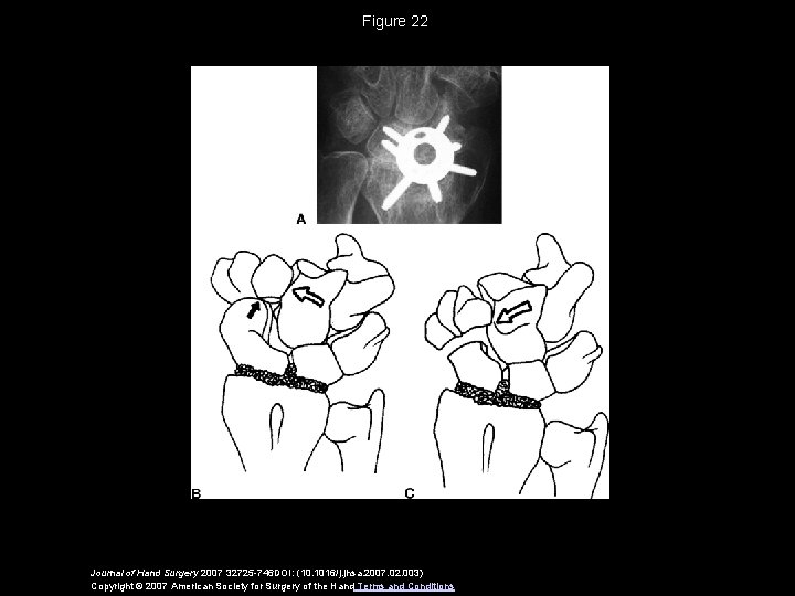 Figure 22 Journal of Hand Surgery 2007 32725 -746 DOI: (10. 1016/j. jhsa. 2007.