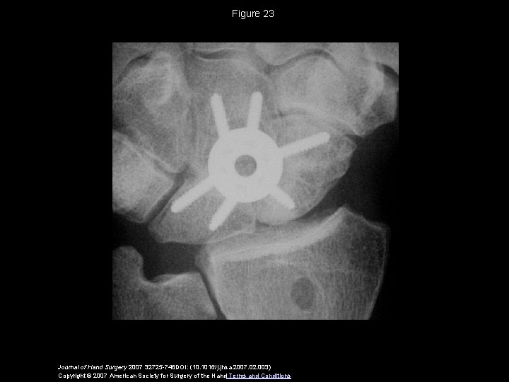 Figure 23 Journal of Hand Surgery 2007 32725 -746 DOI: (10. 1016/j. jhsa. 2007.