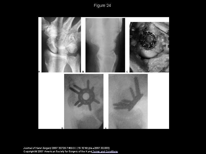 Figure 24 Journal of Hand Surgery 2007 32725 -746 DOI: (10. 1016/j. jhsa. 2007.