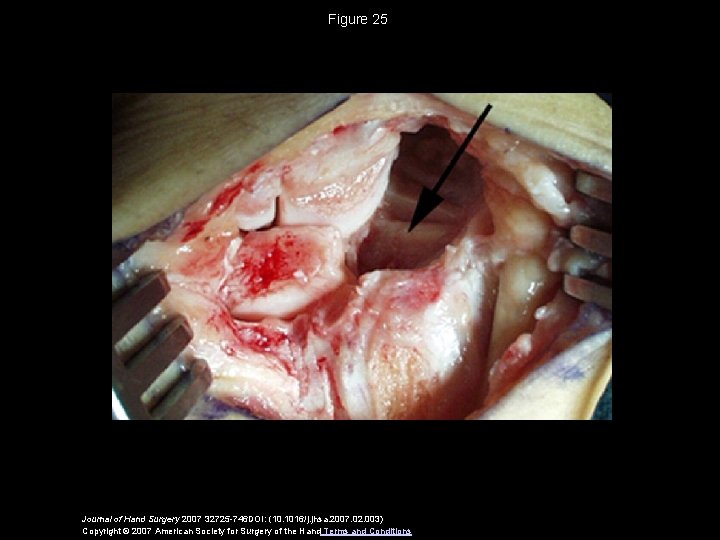 Figure 25 Journal of Hand Surgery 2007 32725 -746 DOI: (10. 1016/j. jhsa. 2007.